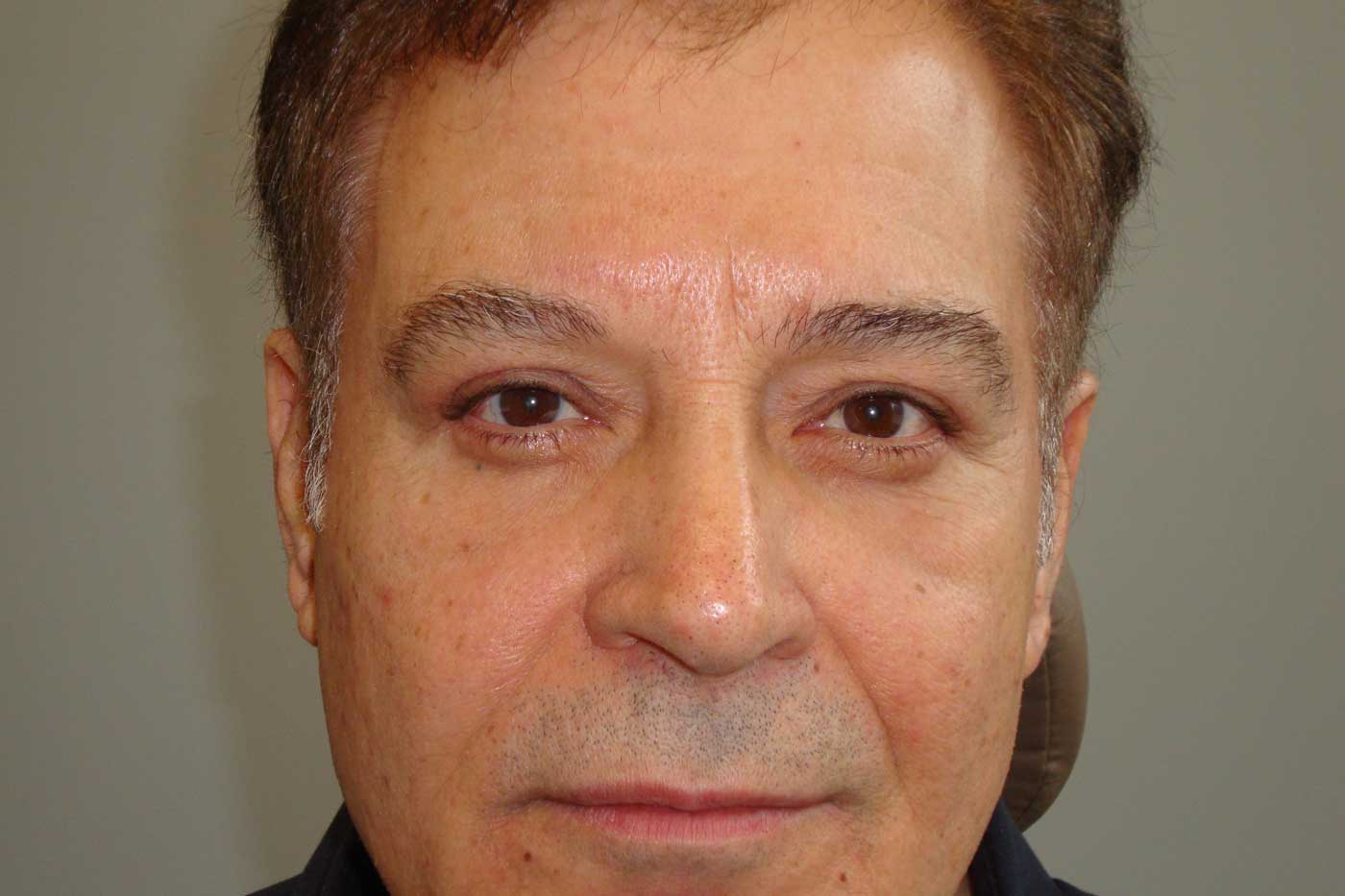 Blepharoplasty Louisville, KY M. Douglas Gossman, MD, PLLC