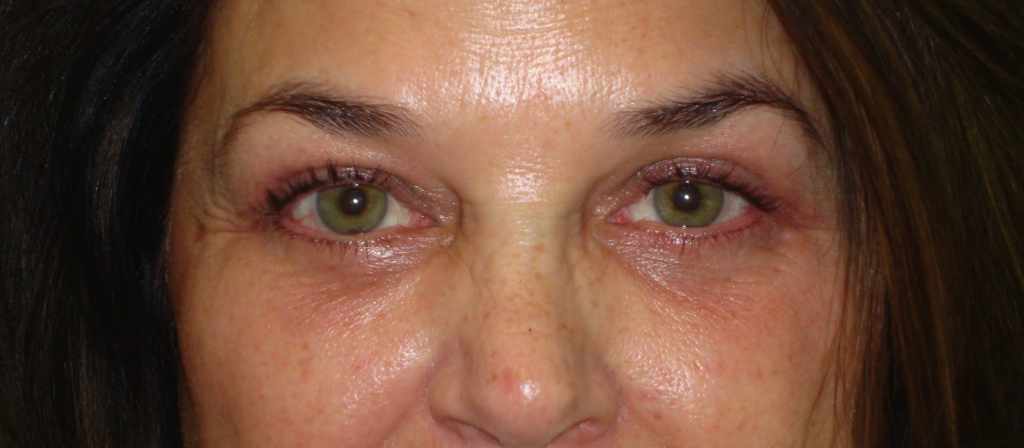 AFTER: Upper and Lower Blepharoplasty with SOOF Lift