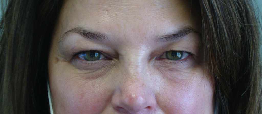 BEFORE: Upper and Lower Blepharoplasty with SOOF Lift